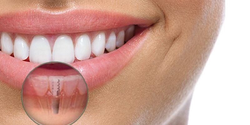Impianti dentali: come prenderti cura di loro